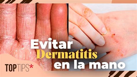 Hongos En Las Manos Cómo Evitar La Dermatitis Top Tips Youtube