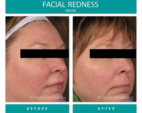 Before And After Gallery Facial Redness Vbeam Derick Dermatology