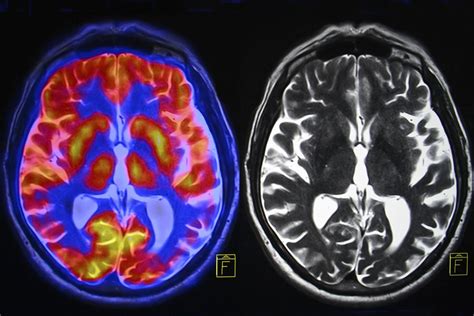 Brain Imaging Research Is Often Wrong This Researcher Wants To Change