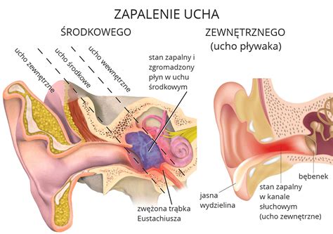Zapalenie ucha Objawy higiena i łagodzenie bólu Leczenie Profilaktyka
