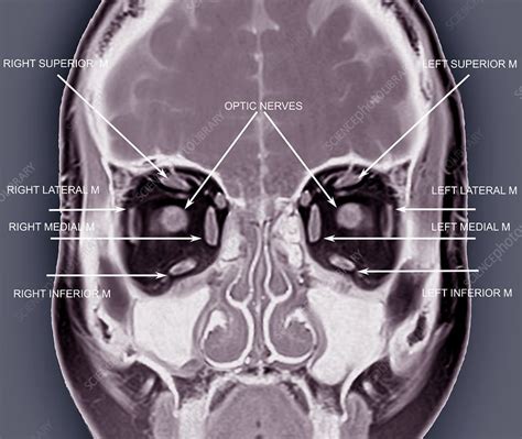 Eye Anatomy And Muscles Mri Scan Stock Image C0337451 Science