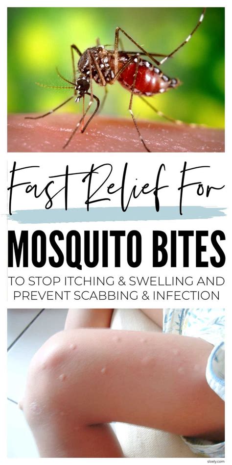 Diy Mosquito Bite Remedies Remedies For Mosquito Bites Mosquito Bite