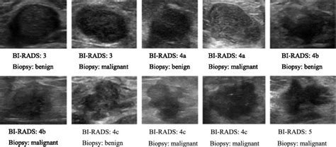 Example Cases Of Breast Ultrasound Images The Corresponding