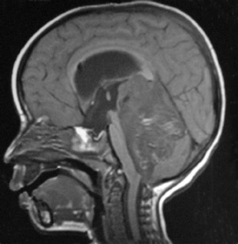 Contrast Enhanced Sagittal T1 W Mr Image Of The Brain Shows Complete