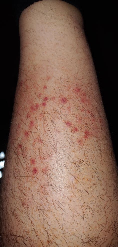 Help Non Itchy Rash On Lower Shin Feels Bruised Feels Swollen What
