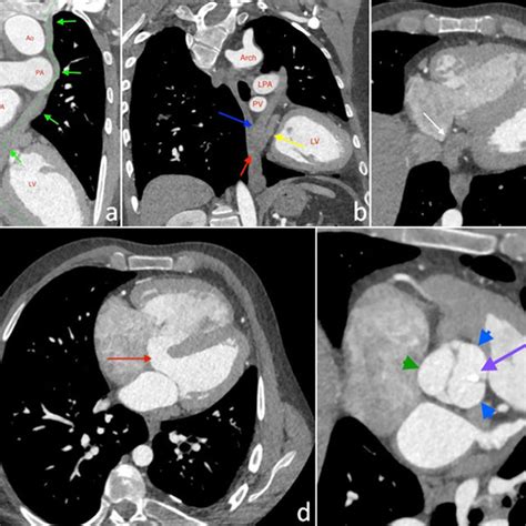 Bicuspid Aortic Valve Bav Classification Bav Ap Was Defined As An Download Scientific