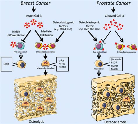 Roles Of Gal 3 In The Bone Microenvironment In Breast Cancer Bone