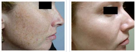 Beverly Hills Photofacial Ipl For Pigmentation And Sun