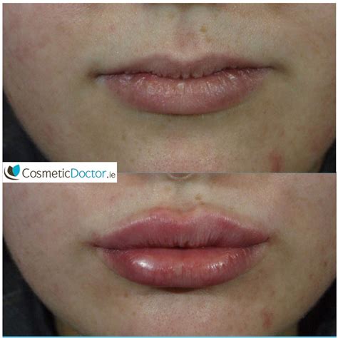 Before And After Photo Gallery Cosmetic Doctor Dublin