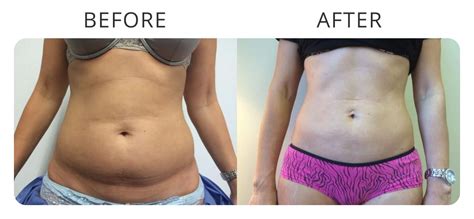 Liposuction Before And After Gallery Mcc Sydney