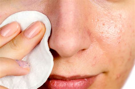 Natural Remedies For Blackheads You Can Use At Home The Healthy