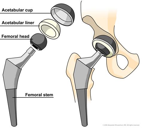 Total Hip Replacement Surgery In Nyc Alexander Mclawhorn Md