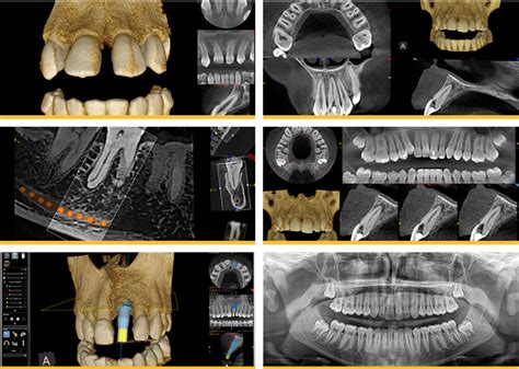 3d Ct Scan Imaging For Dental Implant Surgery In Vancouverand Burnaby Bc
