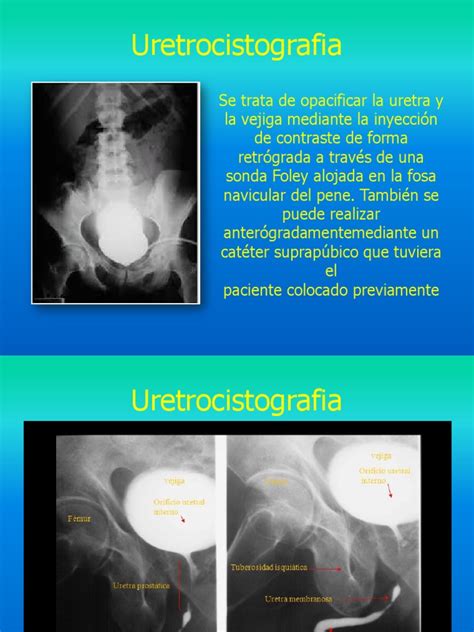 Uretrocistografia Seminario Gustavo Pdf Urología Medicina