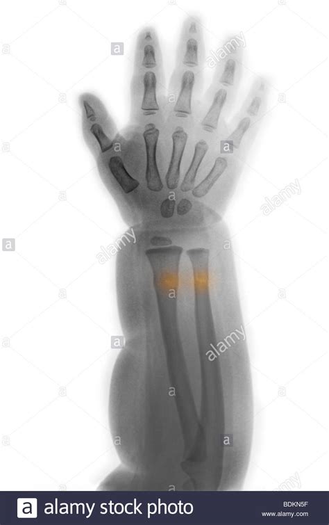 X Ray Of The Forearm Of An Infant Showing A Greenstick Buckle