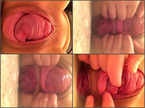 Papanicolau Cervical Hot Sex Picture
