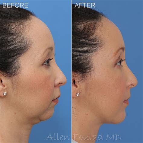 Liposuction For Sagging Jowls Cosmetic Surgery Tips