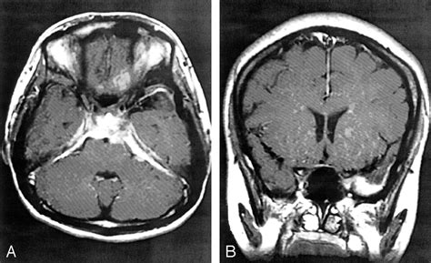 Idiopathic Hypertrophic Cranial Pachymeningitis Case Report With 7
