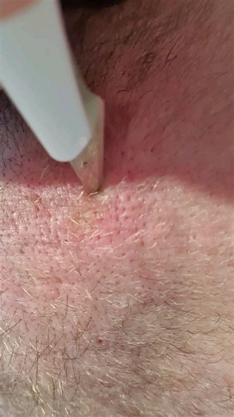 Infected Cyst On The Back Of My Head Popping