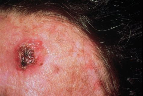 Skin Cancer Pictures Most Common Skin Cancer Types With Images Reverasite