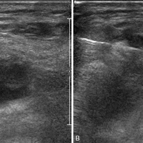 A Transverse Ultrasound View Of The Left Supraclavicular Area Shows