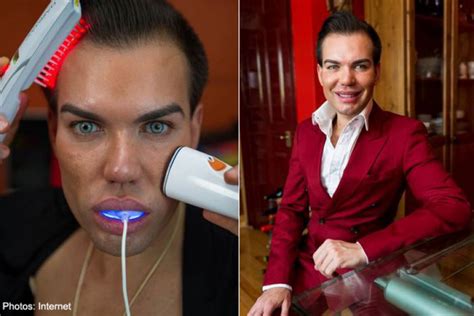 Man Spends 351 000 On Cosmetic Procedures To Look Like Real Life Ken Doll Health Health