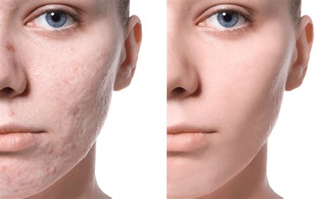 Acne Dark Spots Treatment