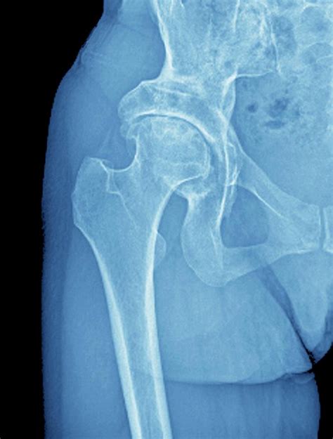 X Ray Of Hip With Osteoarthritis Photograph By Zephyrscience Photo Library