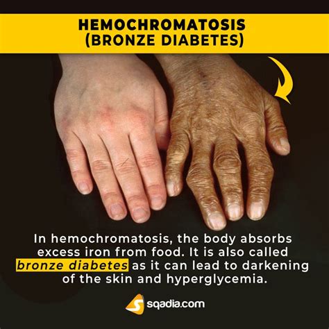 Hemochromatosis Medical Videos Body Tissues Medical Facts