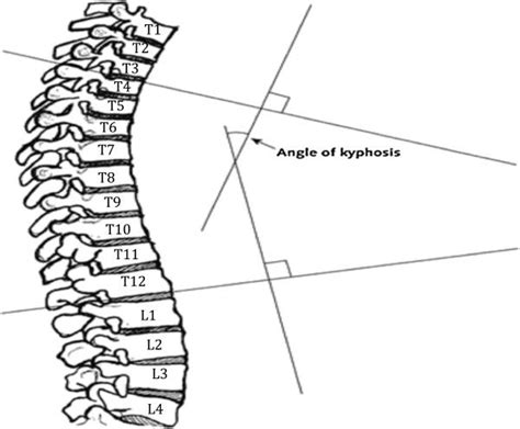 Cobb Angle Of Kyphosis Measured As The Angle Of Intersecting Lines