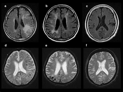 Representative Brain Mris Of A Caa I Patient And Ad Patients With Or
