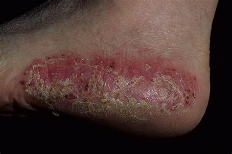 Pustular Psoriasis On Feet Pictures Symptoms And Pictures