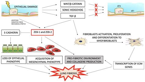 Medicina Free Full Text Epithelialmesenchymal Transition In The