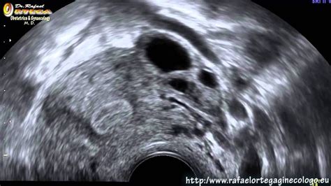 Ecografia Ginecologica 2d Hd Utero Normal Durante La Ovulación Dr