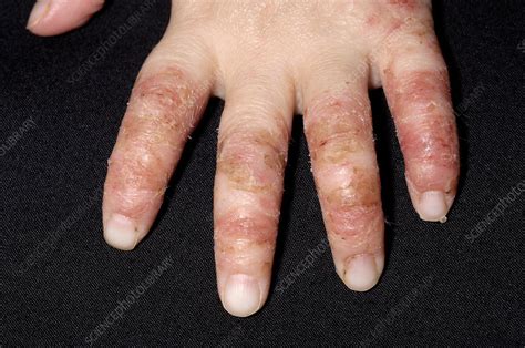 Infected Eczema Stock Image M1500315 Science Photo Library