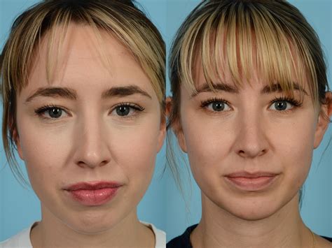 Rhinoplasty Before And After Photos Patient 614 Chicago Il Tlkm