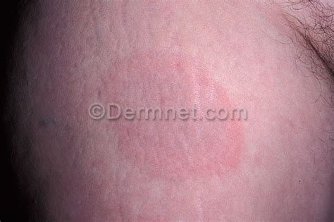 Lyme Disease Photo Skin Disease Pictures
