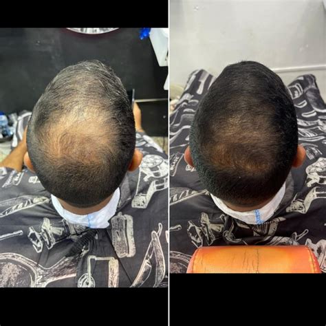 6 5 month progress with dustasteride topical minoxidil and microneedling r tressless