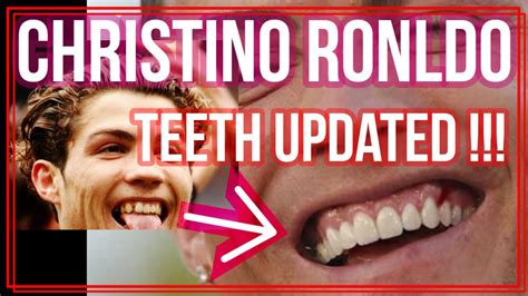 Christiano Ronaldo Teeth Newly Updated Before And After 🤓 Then And Now
