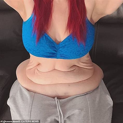 Minnesota Woman Loses Lbs And Spends To Remove Loose Skin