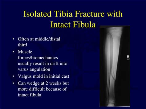 Ppt Fractures Of The Tibia And Fibula In The Pediatric Patient