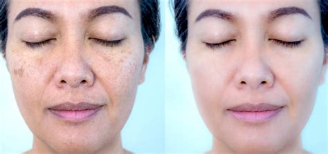 What Is Tri Luma Cream Topical Therapy For Melasma Okdermo Skin Care