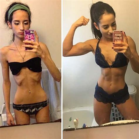 Before After Photos Of People Who Beat Anorexia True Activist