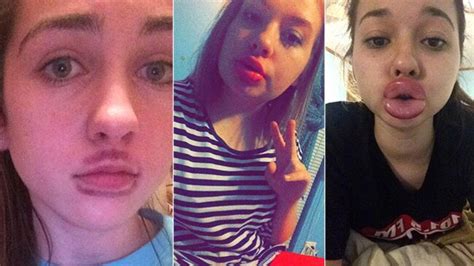 kylie jenner s pouty lips inspire teen girls to use dangerous home remedies for the same look
