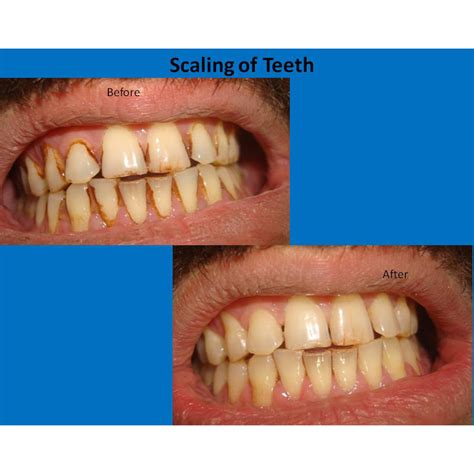 I will have gaps after scaling; Everything you need to know about teeth scaling | Latest ...