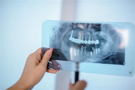Dental X Ray Costs And What Are Your Options Dental Aware Australia