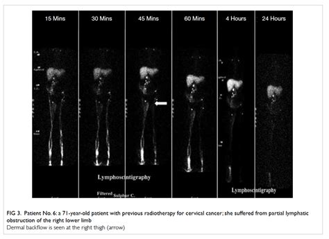 Lymphoscintigraphy In The Evaluation Of Lower Extremity Lymphedema