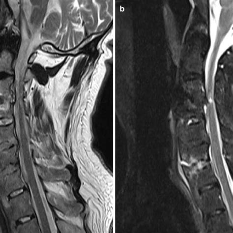 A Sagittal T Weighted MR Image Of Cervical Spine Demonstrating Download Scientific