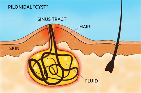 Pilonidal Cyst Recovery Time Things To Know After Surgery