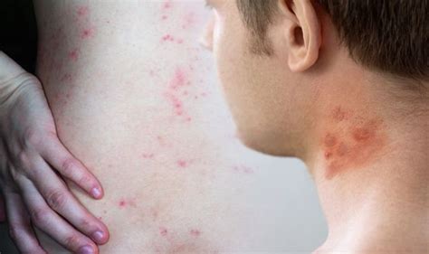 Eczema Rash Pus Filled Bumps Could Indicate A Skin Infection Express